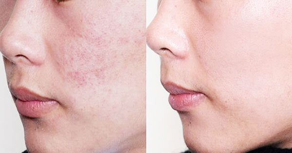 thanh lăn trị mụn Dr Spiller Roll-on