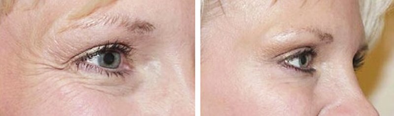 Kem chống lão hóa vùng mắt DR Spiller CBC Recovering Eye Contour Cream