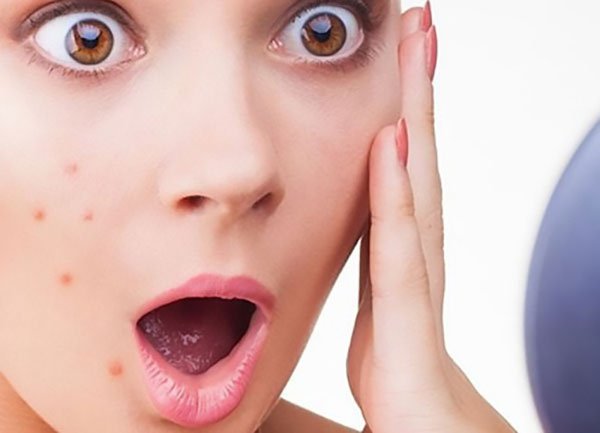 Những quan niệm sai lầm khiến bạn không thể trị mụn tận gốc