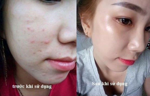 Mặt nạ giảm nhờn, trị mụn Image Clear Cell Medicated Acne Masque