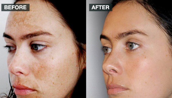 iluma intense bleaching serum