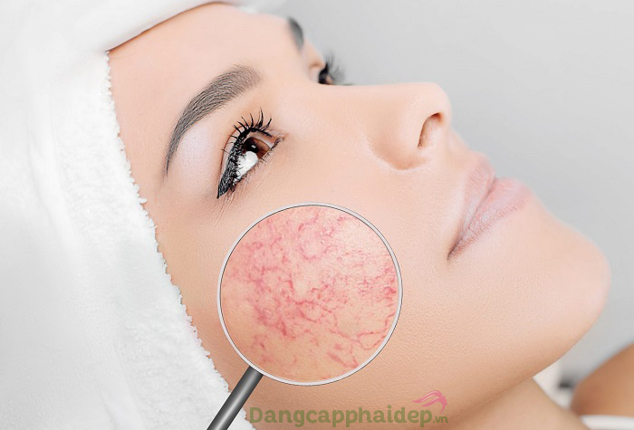 Nổi mạch máu trên da mặt có thể do yếu tố di truyền