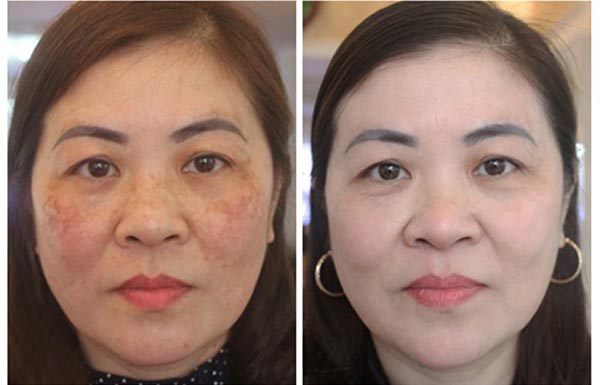 Kem trị nám cao cấp Obagi Nuderm Clear (số 3)