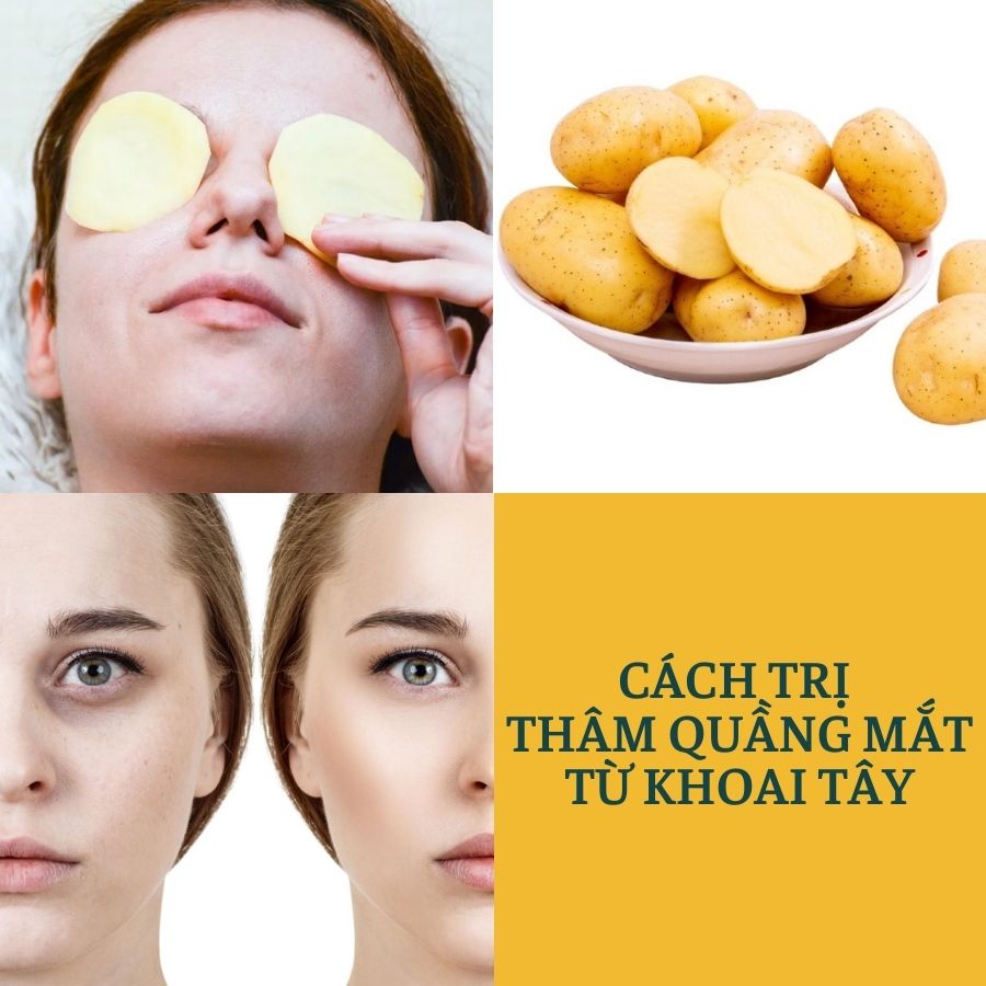 Hướng dẫn cách trị thâm quầng mắt bằng khoai tây