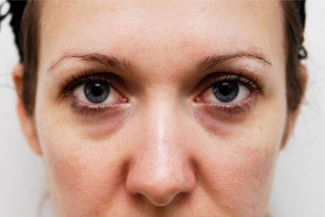 Mặt nạ chống lão hóa da vùng mắt Carita Progressif Anti-Rides Supreme Wrinkle Solution Eye Patch
