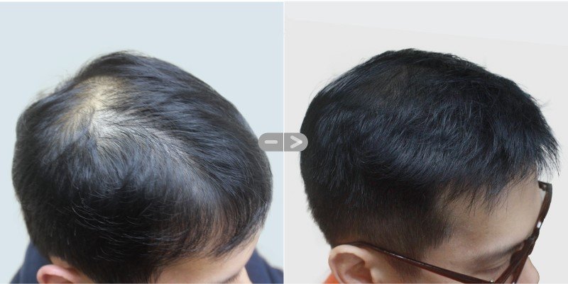 Maxroot Cosmetic Scalp Hair Root Massage Gel – Gel kích thích mọc tóc và điều trị tóc bạc bán chạy hàng đầu tại Nhật Bản