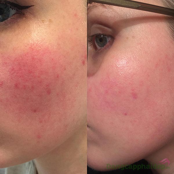 Da sau điều trị lăn kim, laser...rất mỏng yếu, dễ kích ứng, ửng đỏ, thậm chí là viêm da...