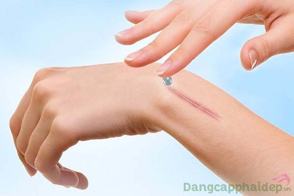 Sử dụng gel trị sẹo 2 lần mỗi ngày lên những vùng da cần điều trị.=