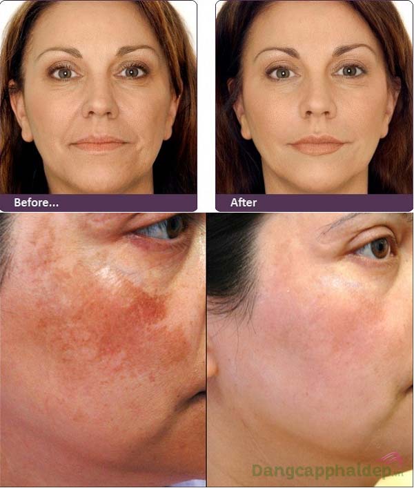 Trước và sau khi sử dụng kem chống lão hóa, làm mờ thâm nám Image MD Restoring Retinol Crème