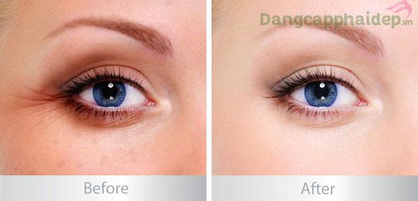 Trước và sau khi sử dụng mặt nạ Swissline Algae Peptide Eye Mask