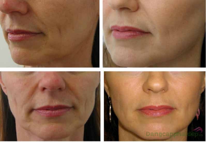 Skincode Cellular Line Wrinkle Filler làp giải pháp tối ưu nhất dành cho da lão hóa, xuất hiện nếp nhăn, vết chân chim...