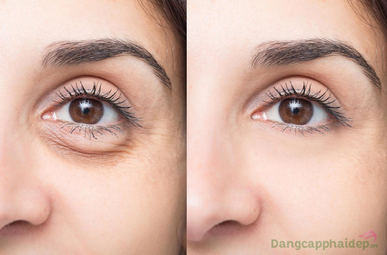 Trước và sau khi sử dụng serum xóa nhăn vùng mắt Skincode Cellular Wrinkle Prohibiting Eye Serum