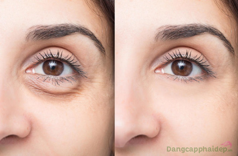 Trước và sau khi sử dụng kem xóa nếp nhăn vùng mắt Neova Refining Eye Lift