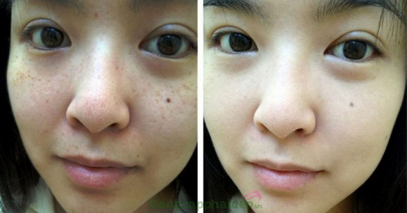 Trước và sau khi sử dụng serum trị đốm nâu dưỡng trắng da Codexial Effasun Bright 15%
