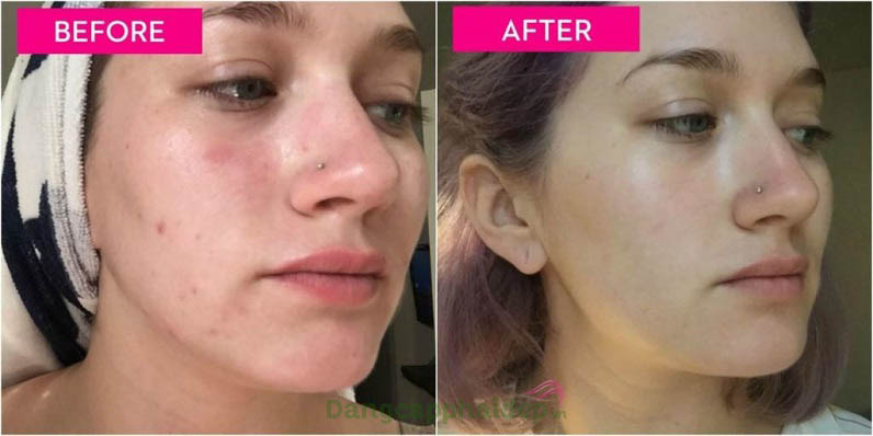 Muốn làm sạch, trị mụn và ngừa thâm sau mụn hãy sử dụng sữa rửa mặt Clear Cell Medicated Acne Facial Scrub