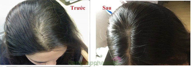 Khách hàng review trước và sau khi sử dụng tiêm mọc tóc và chống rụng tóc Md:Ceuticals Md Complex Hair-Revit