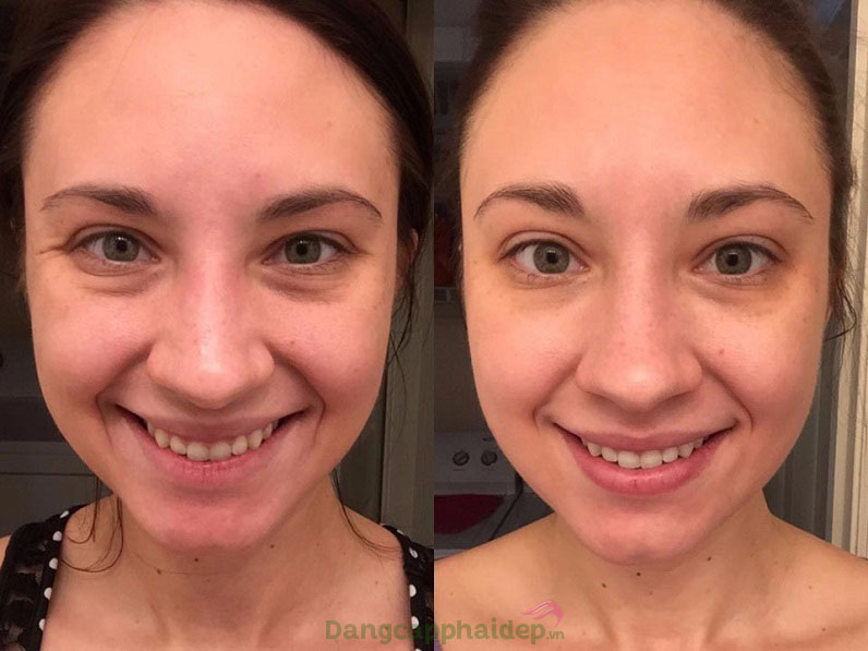 Hình ảnh trước và sau khi sử dụng Md:ceuticals Md Cocktail Post Treatment Skin Recovery