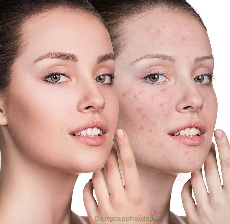 Trước và sau khi sử dụng tiêm trị mụn ngừa sẹo thâm Md:ceuticals Md Complex Skinclear
