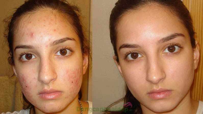 Hình ảnh trước và sau khi sử dụng kem trị mụn ngừa thâm Mesoestetic Acne One