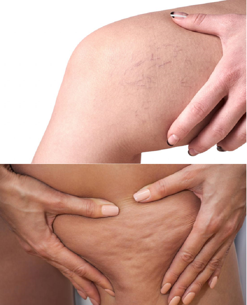 Hãy sử dụng sản phẩm khi da có dấu hiệu suy giãn tĩnh mạch, sần vỏ cam...