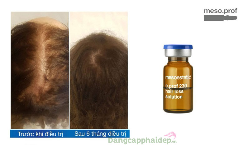 Trước và sau khi điều trị với dung dịch trị rụng tóc Mesoestetic C.Prof 230