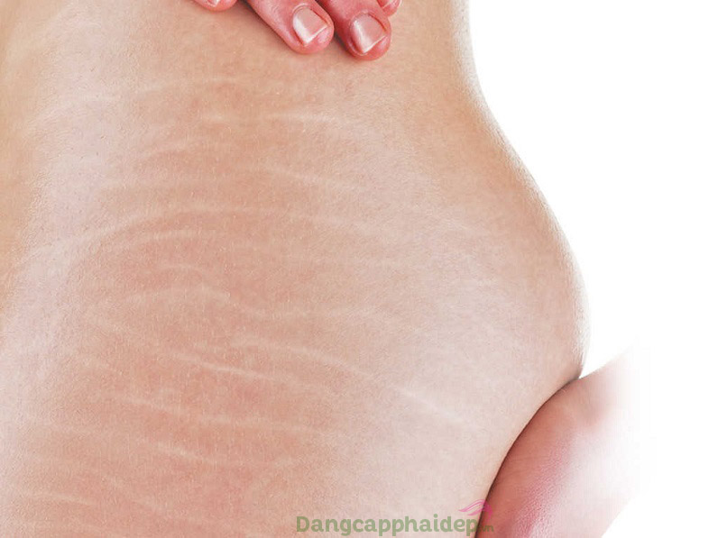 Bạn đang tìm giải pháp khắc phục các vết rạn da trên cơ thể?