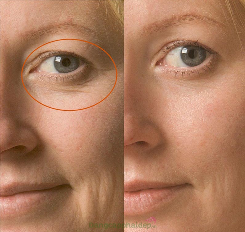 Muốn cải thiện nhanh các nếp nhăn vùng mắt, hãy sử dụng Obagi Clinical Kinetin Hydrating Eye Cream