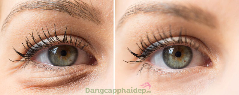 Muốn cải thiện nhanh quầng thâm, nếp nhăn mắt khi sử dụng Obagi Clinical Vitamin C Eye Brightener