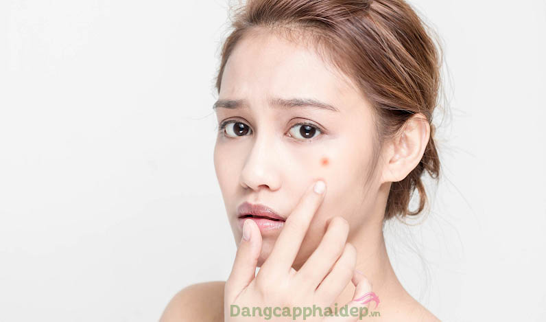 Ám ảnh vì những nốt mụn hoành hành