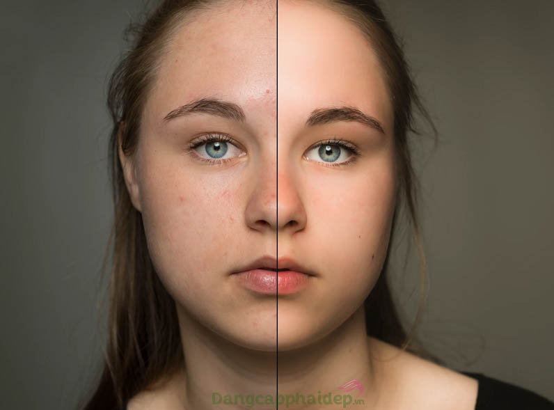 Sự cải thiện rõ rệt trên da mặt sau khi sử dụng kem trị mụn che khuyết điểm Mesoestetic Imperfection Control