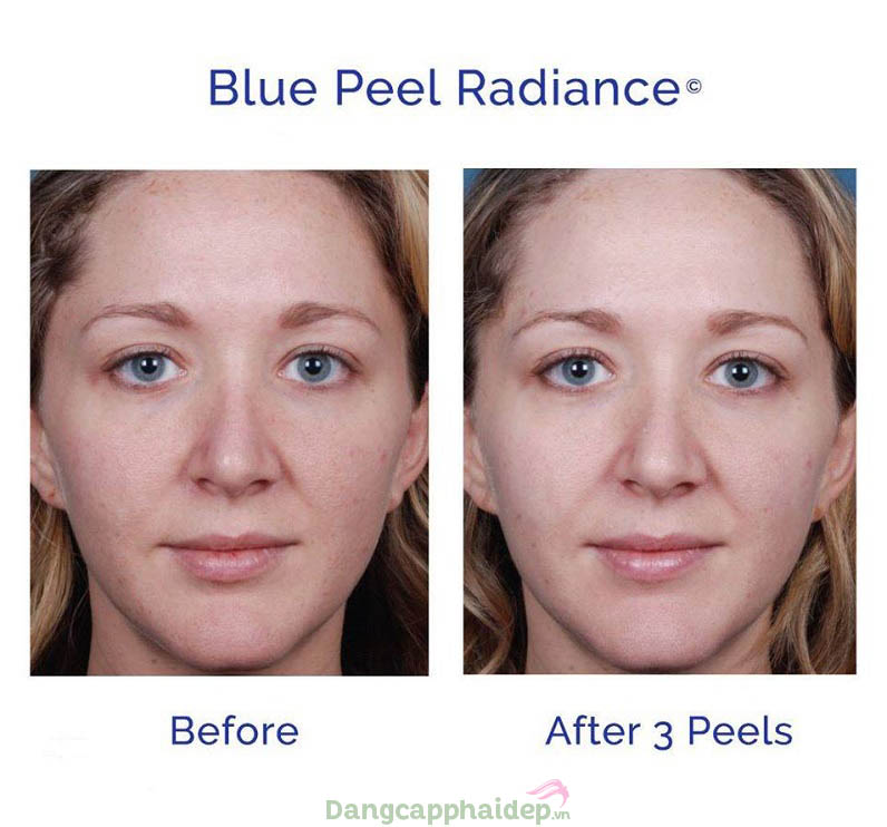 Làn da thay đổi tích cực sau liệu trình sử dụng Obagi Blue Peel Radiance Kit
