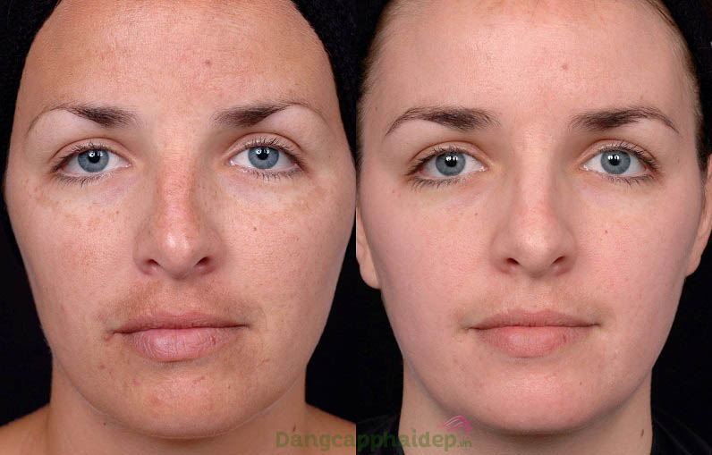 Làn da cải thiện tích cực từng ngày khi sử dụng Obagi C Fx System C-Clarifying Skin Brightening Serum