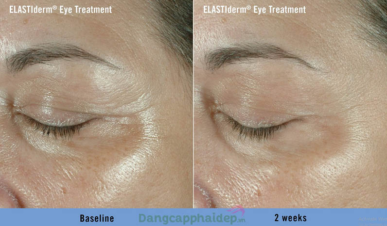 Làn da vùng mắt thay đổi tích cực chỉ sau 2 tuần dùng Obagi ELASTIderm Eye Treatment Gel