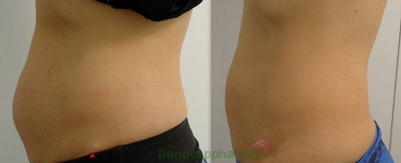 Mỡ thừa ở bụng, đùi, cánh tay...điều được loại bỏ nhanh chóng sau khi tiêm Mesoestetic C.prof 221 Lipolytic Solution