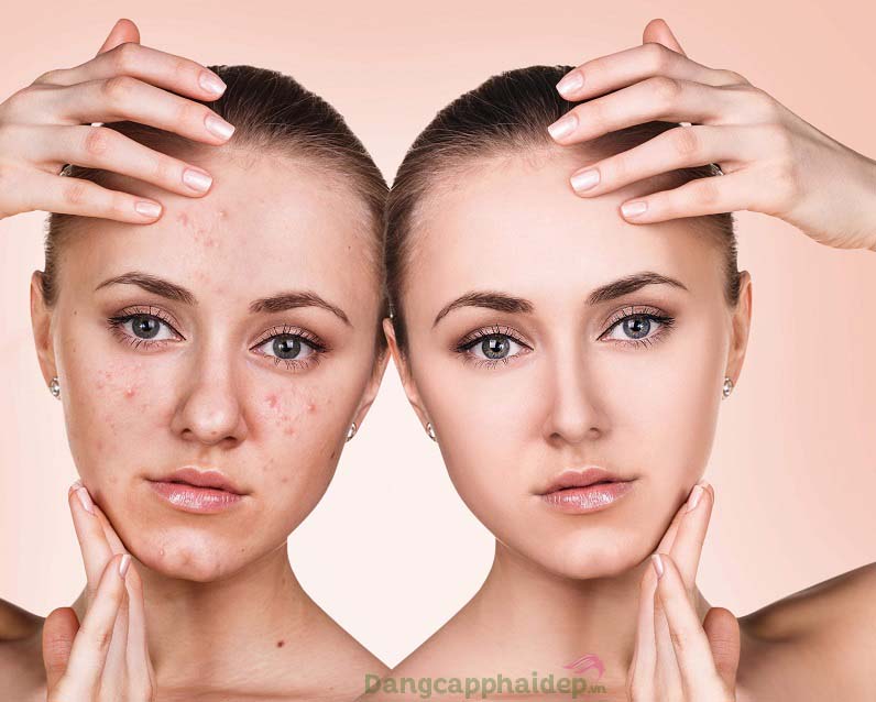 Điều trị và ngăn ngừa mụn hiệu quả khi sử dụng peel Mesoestetic Mesopeel Salicylic 30%