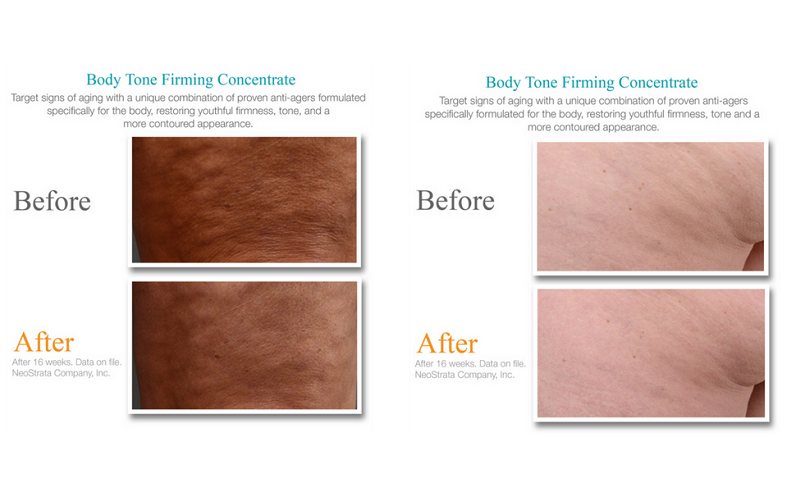 Trước và sau khi sử dụng Exuviance Body Tone Firming Concentrate