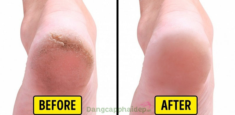 Trước và sau khi sử dụng Exuviance Heel and Elbow Dry Skin Repair