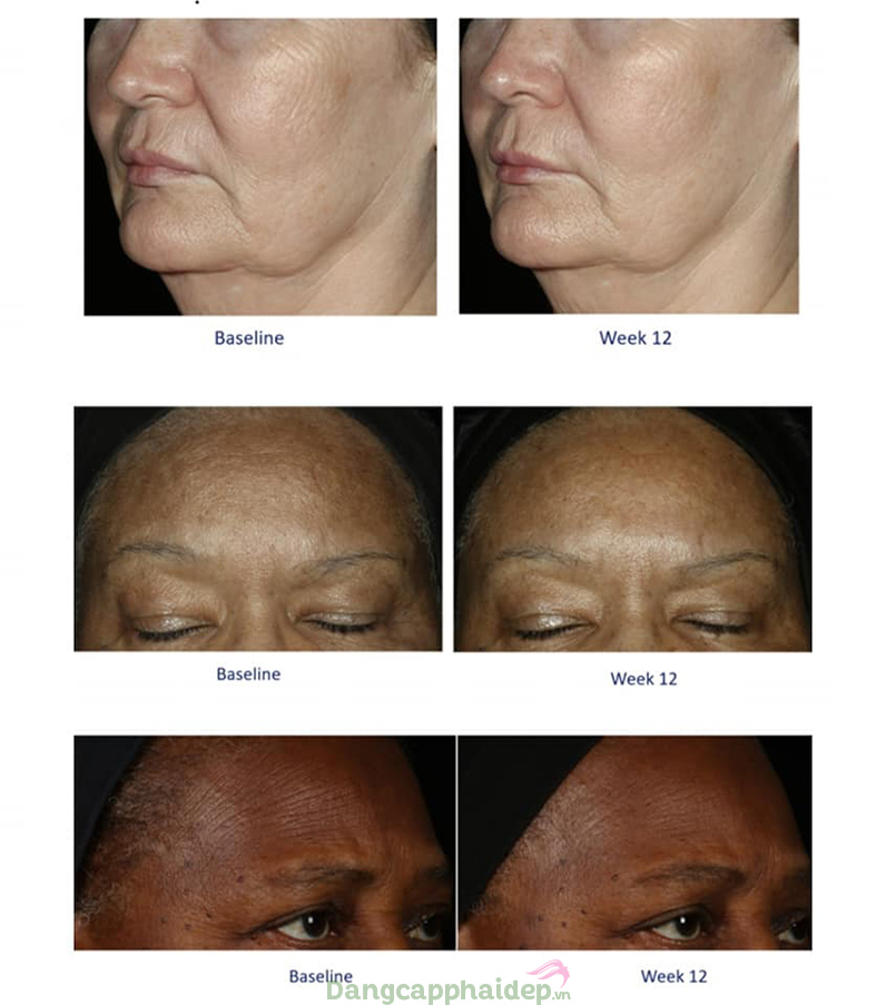 Obagi Elastiderm Facial Serum cải thiện nếp nhăn, nâng cơ hiệu quả sau 12 tuần sử dụng.