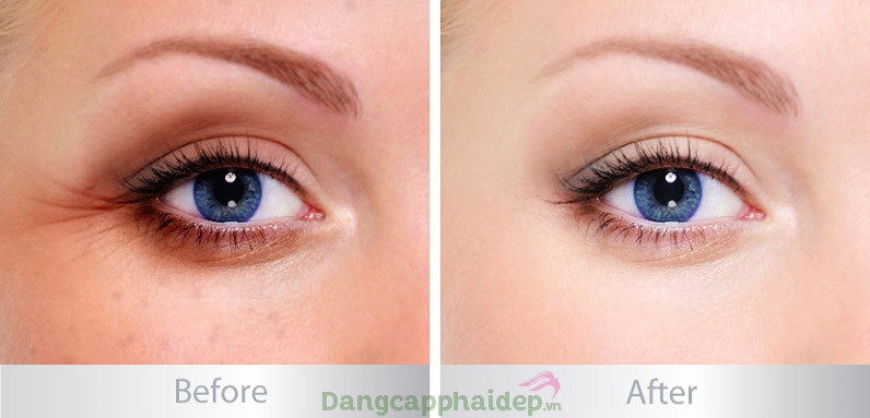 Cải thiện các khuyết điểm trên vùng da quanh mắt chỉ sau khoảng 4 tuần sử dụng Etre Belle Skinvision Eye Cream