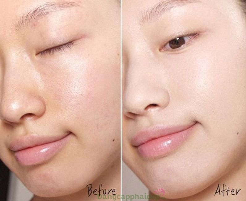 Làn da thay đổi tích cực từng ngày khi sử dụng tinh chất Dr Spiller Mountain Creek Balnace Purifying Ampoule