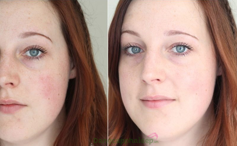 Trước và sau khi sử dụng serum làm sáng da mờ nám Ageless Total Intense Brightening Serum