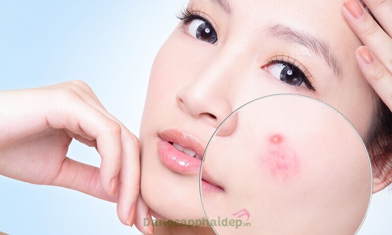 Sữa rửa mặt dành cho da mụn Frezyderm Ac-Norm Active Cleanser