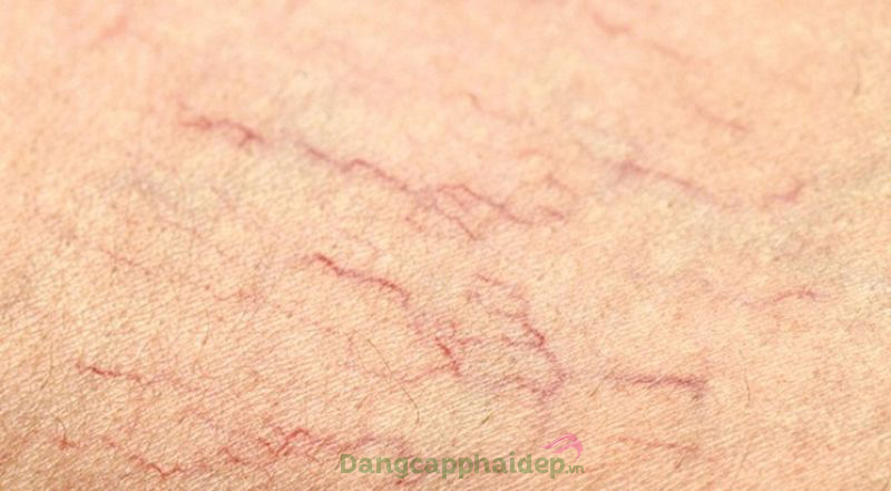 Làn da trở nên mỏng manh, xuất hiện nhiều mao mạch.