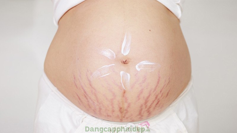Sự tăng giảm đột ngột khi mang thai và sau sinh khiến mẹ bầu dễ bị rạn da.