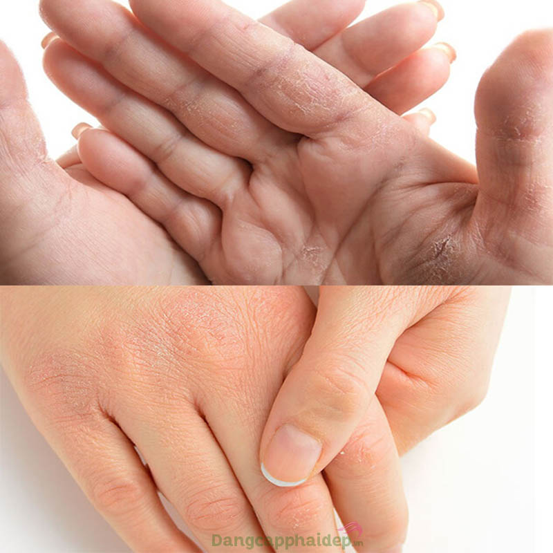 Đừng để đôi tay khô ráp, lão hóa sớm chỉ vì lơ là chăm sóc.