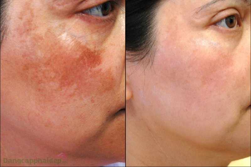 Zo Skin Health Skin Brightening Program