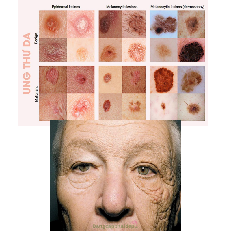 Hình ảnh ung thư da và hình ảnh người tài xế với một bên mặt nhiều nếp nhăn do tiếp xúc ánh nắng.