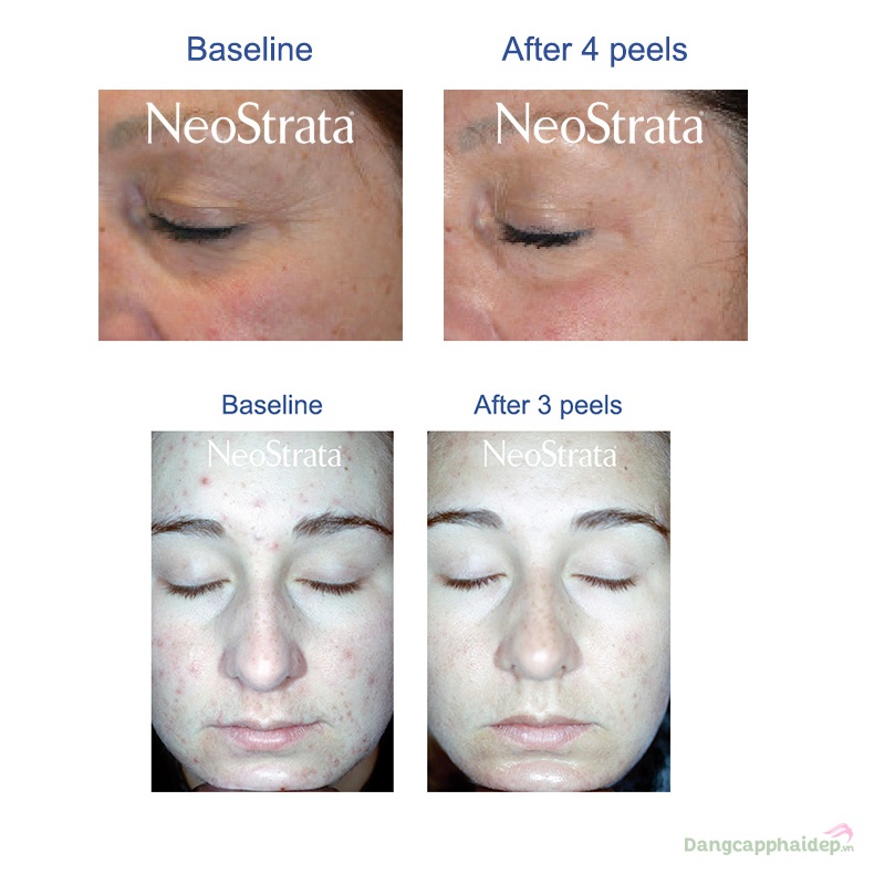 NeoStrata 35% Glycolic Acid Skin Renewal Peel 