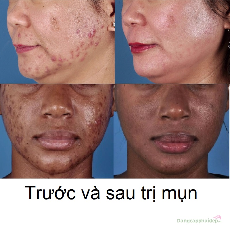 Zo Skin Health Acne Prevention Treatment Program