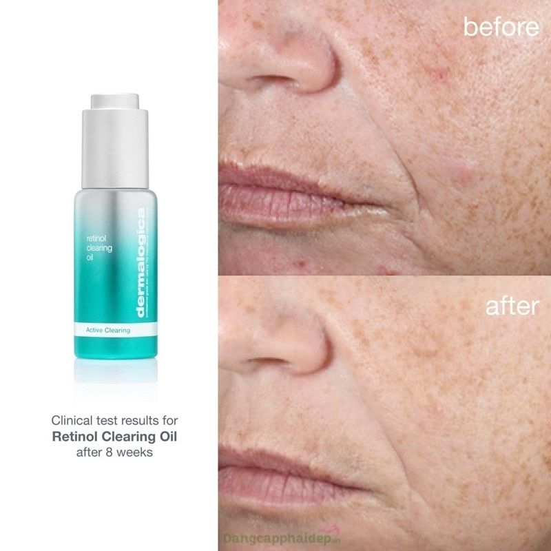 Muốn cải thiện da lão hóa, ngăn ngừa mụn hãy sử dụng Dermalogica Retinol Clearing Oil.